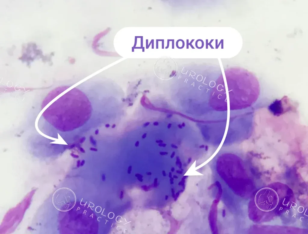 Статеві інфекції
